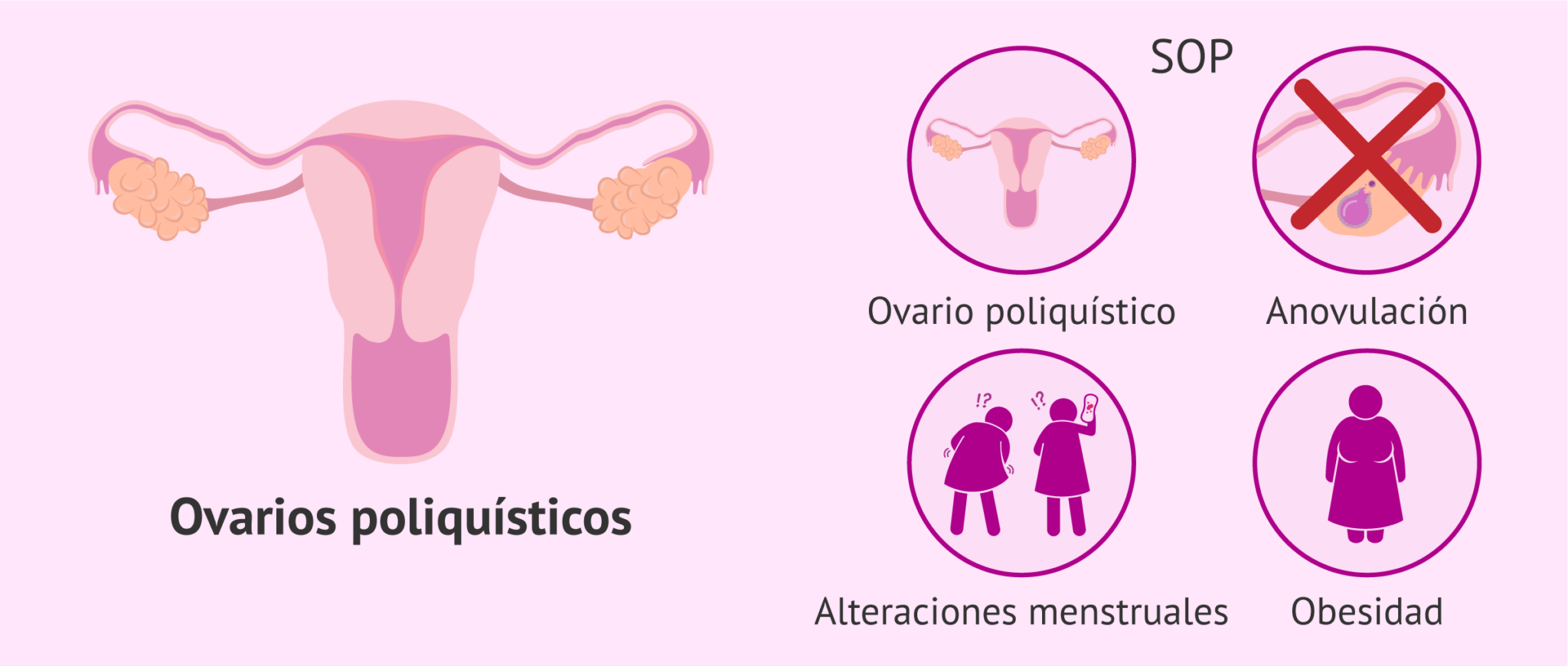 Qué es el síndrome de ovarios poliquísticos SOP Por qué aparece