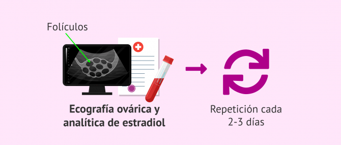 Imagen: Hiperestimulación ovárica