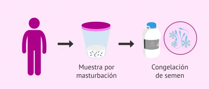 Imagen: Preservación de la fertilidad masculina