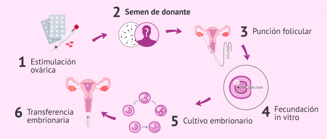 Imagen: Pasos para la FIV con semen de donante