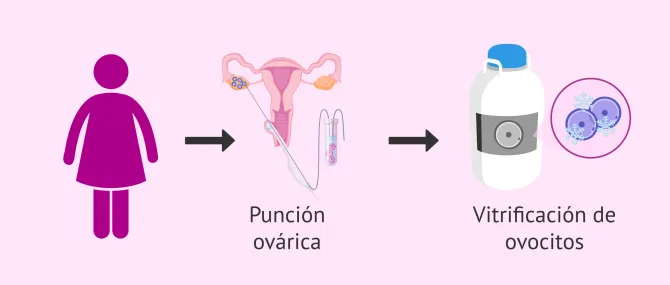 Imagen: Preservación de la fertilidad femenina