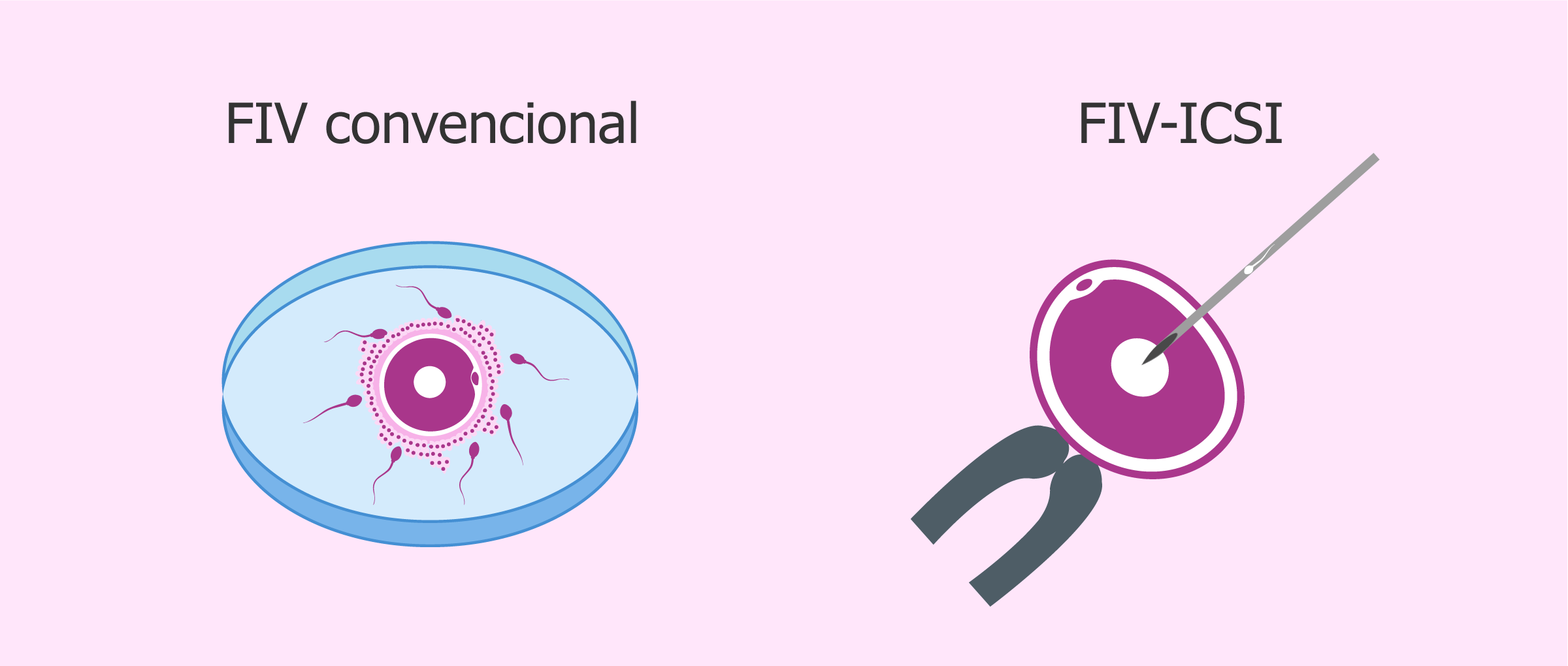 Diferencias entre FIV convencional y ICSI