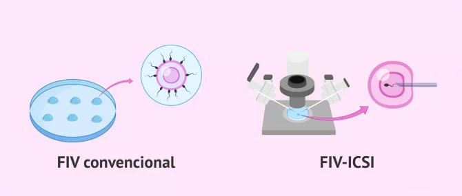 Imagen: FIV convencional o FIV-ICSI