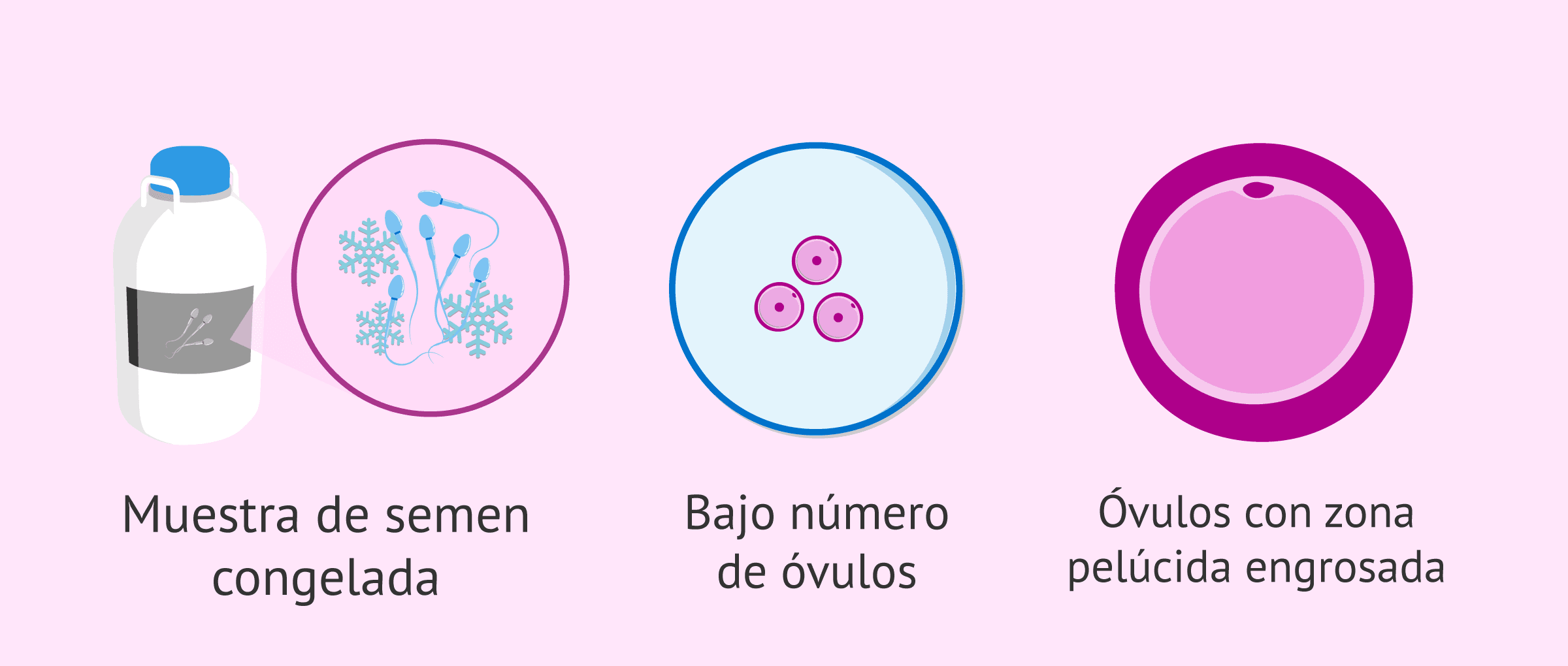 Otras situaciones donde se recomienda ICSI