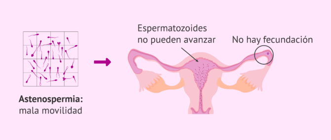 Imagen: Dificultad para que ocurra la fecundación en varones con astenozoospermia
