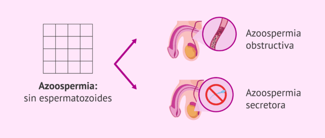 Imagen: Tipos de azoospermia según la causa