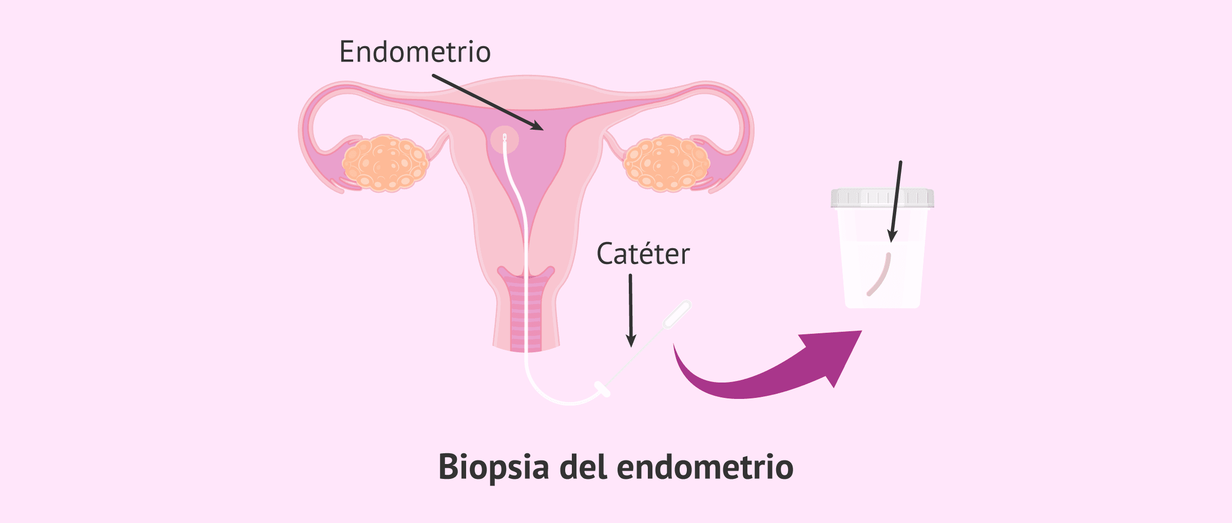 ¿Cómo es la biopsia endometrial?