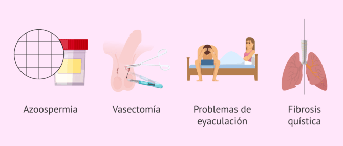 Imagen: Recomendaciones para recurrir a la biopsia del testículo