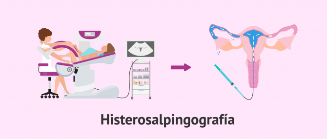 Imagen: Proceso histerosalpingografía