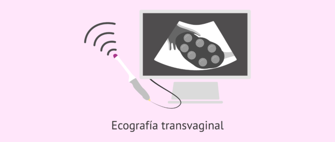 Imagen: ¿Cómo es la ecografía transvaginal?