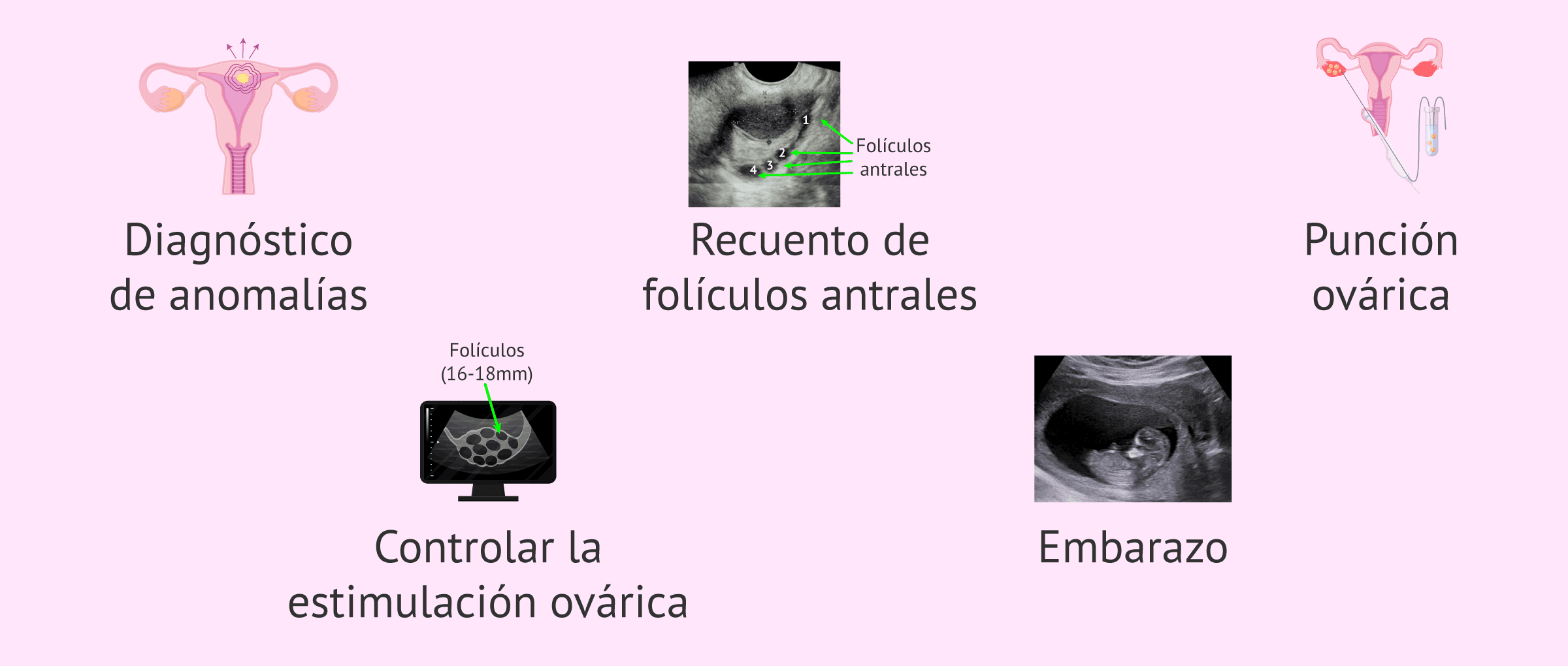 ¿Cuándo se hace una ecografía transvaginal?
