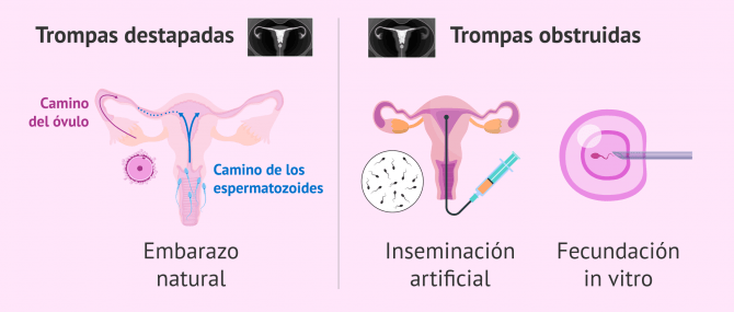 Imagen: Opciones reproductivas después de la HCG