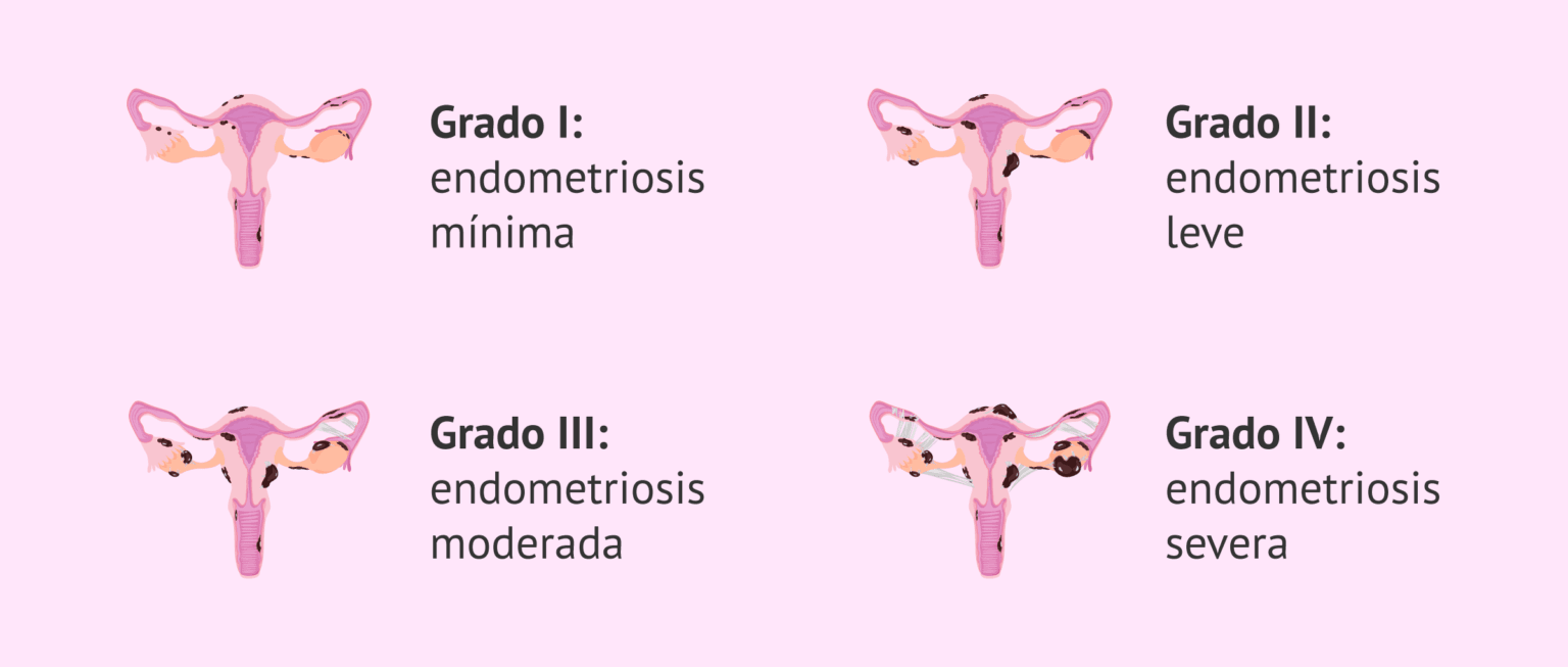 ¿Cómo se clasifica la endometriosis según la ASMR?