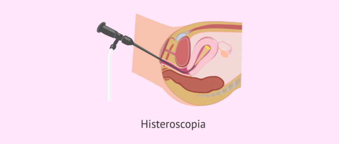 Imagen: ¿Qué es la histeroscopia?