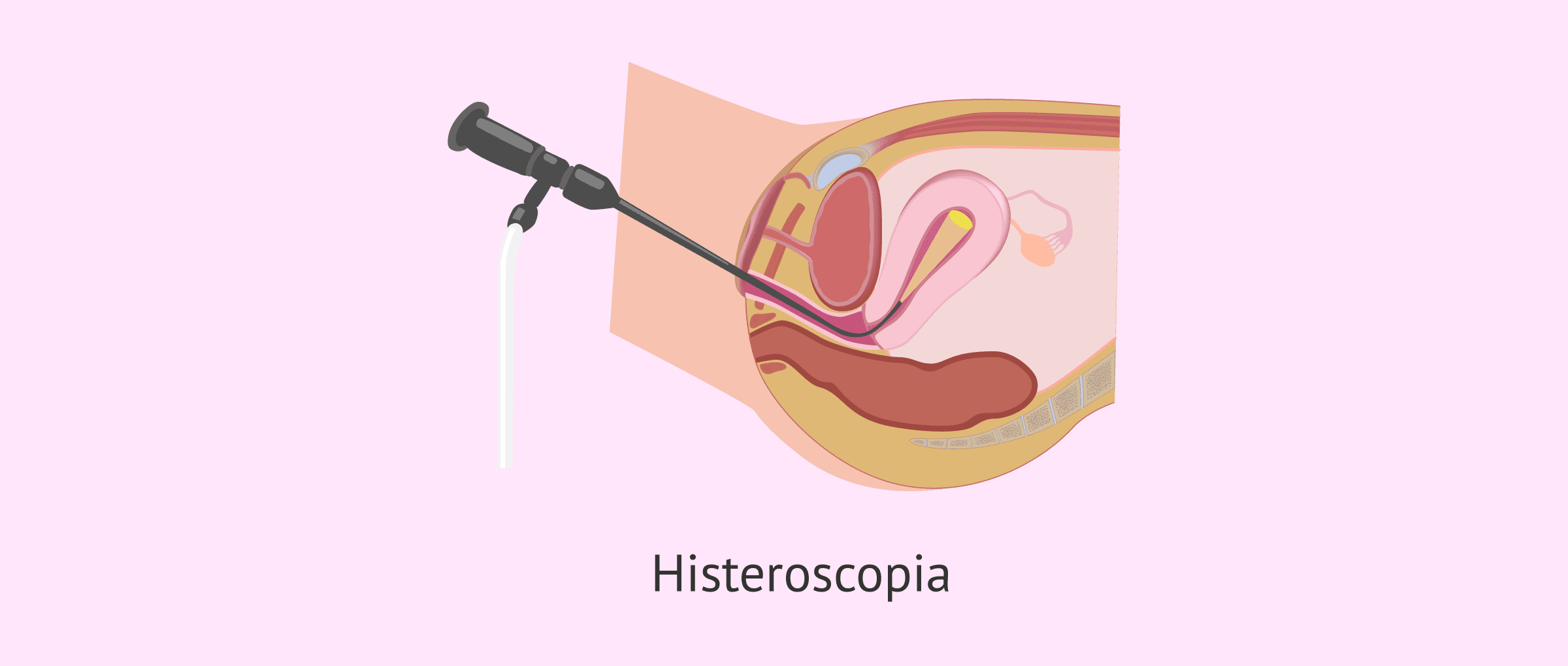 ¿Qué es la histeroscopia?