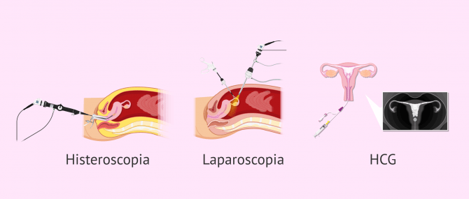 Imagen: Diferencias entre la histeroscopia, laparoscopia y HCG