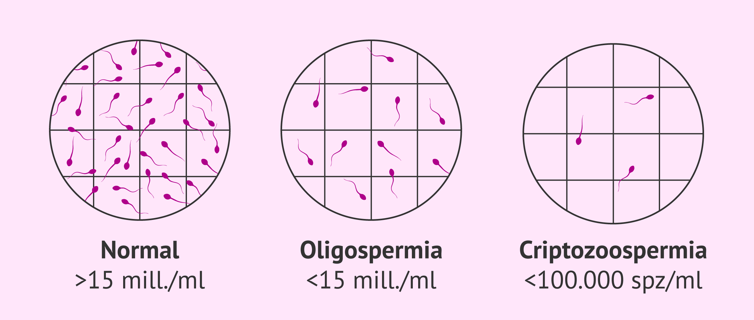 Oligozoospermia y criptozoospermia
