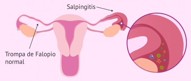 Imagen: Salpingitis por infección bacteriana