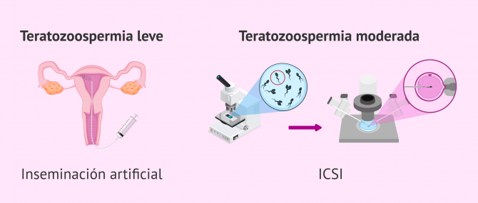 Imagen: Opciones reproductivas para la teratozoospermia
