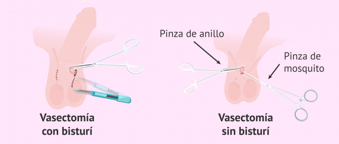 Imagen: Métodos para hacer una vasectomía
