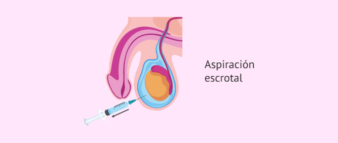 Imagen: Aspiración escrotal del hidrocele