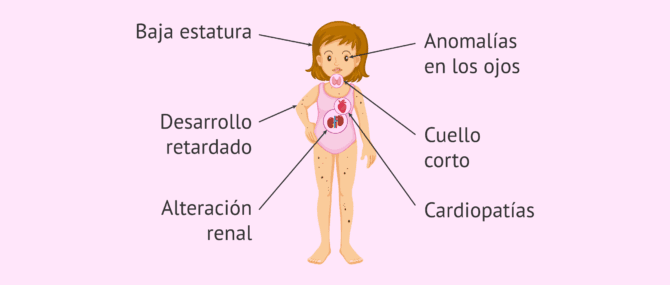 Imagen: Signos y síntomas del síndrome de Turner