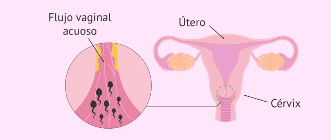 Imagen: Infertilidad en la mujer por factor cervical