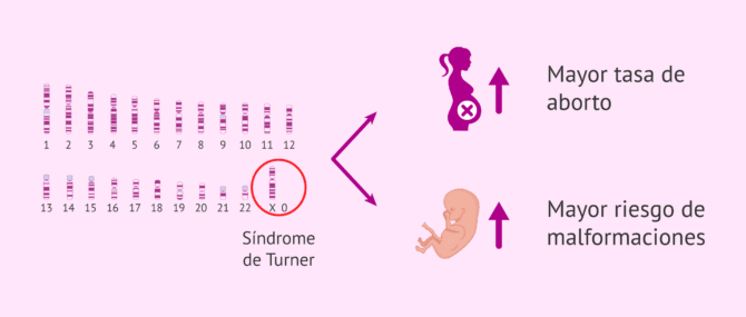 Imagen: Síndrome de Turner y fertilidad