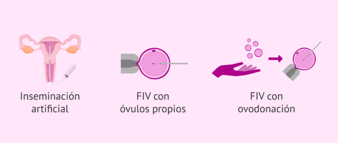 Imagen: Opciones de embarazo en mujeres infértiles