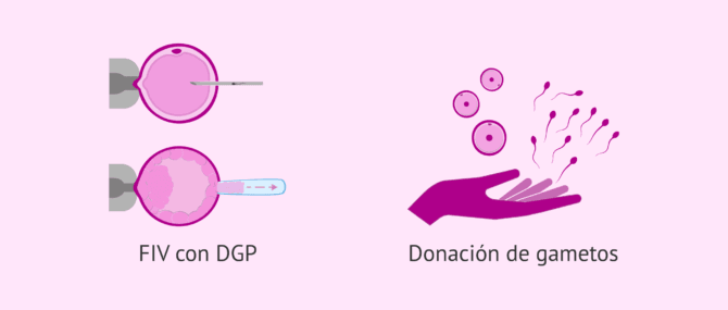Imagen: Opciones de embarazo con síndrome de X Frágil