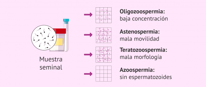 Imagen: Alteraciones seminales y uso de donante de semen