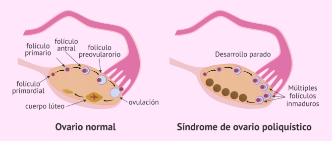 Imagen: Comparación del ovario normal y el ovario poliquistico