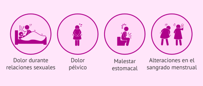 Imagen: Dolor por endometriosis