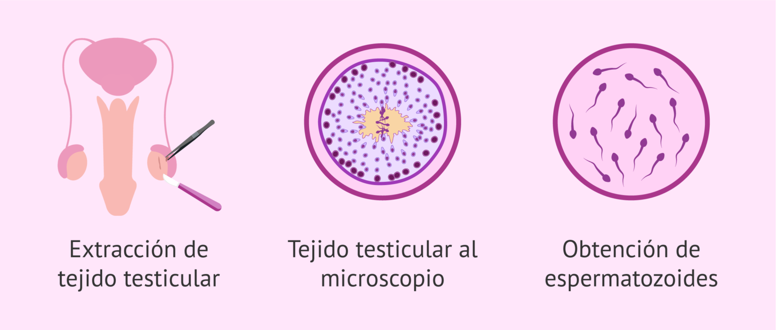 Aspiración De Espermatozoides Del Epidídimo Ovodonante