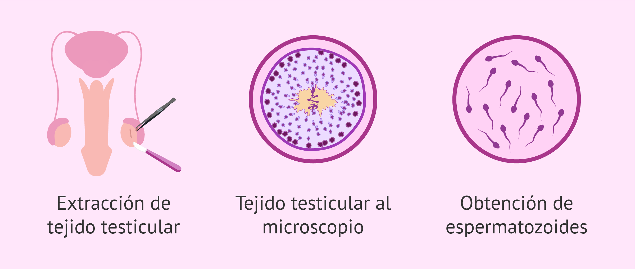 ¿Cómo es la biopsia testicular para extraer espermatozoides?