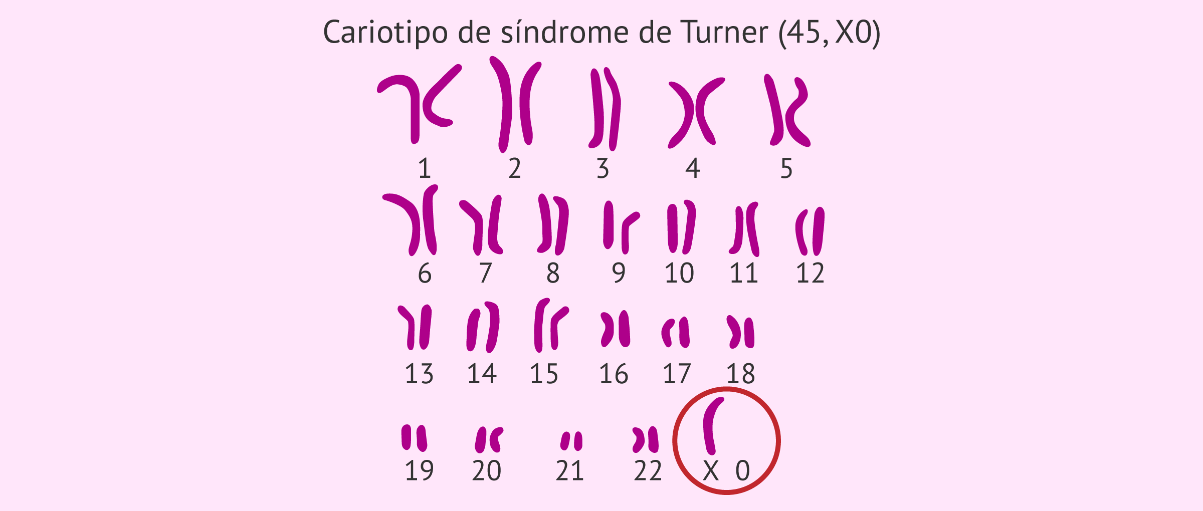 Cariotipo de paciente con síndrome de Turner (45, X0)