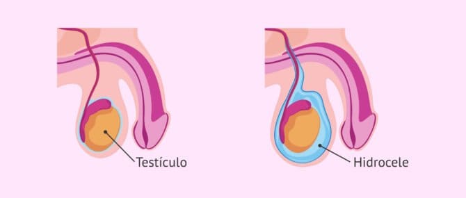 Imagen: ¿Qué es el hidrocele?
