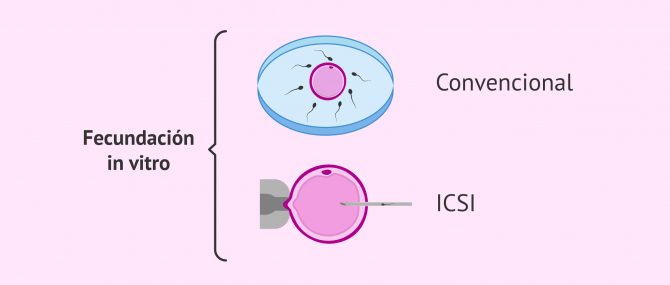 Imagen: TIpos de fecundación in vitro