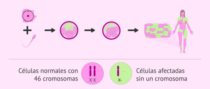 Imagen: Mosaicismo para el síndrome de Turner